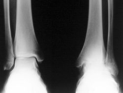Рентген голеностопного сустава
